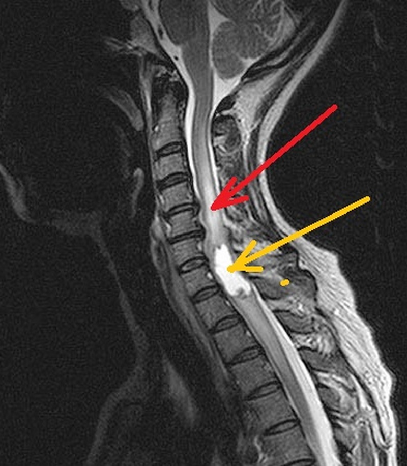 Медулярная опухоль спинного мозга шейный отдел