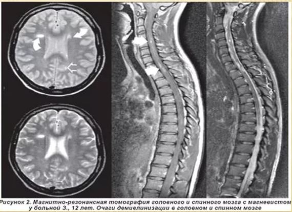 Рассеянный склероз спинного мозга