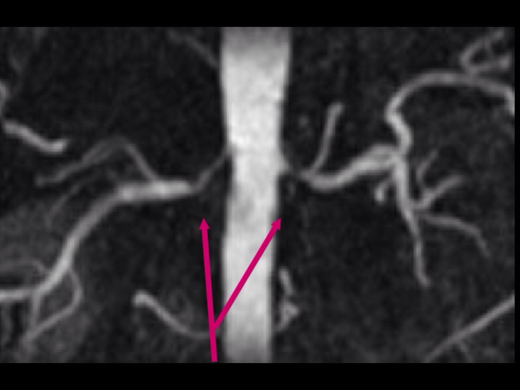 Стеноз почечных артерий