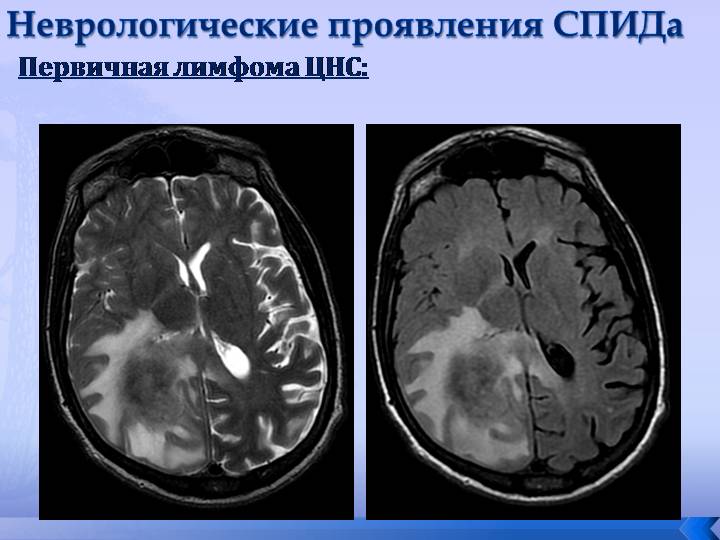 МРТ неврологические проявления спида