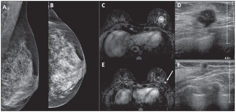 рак груди мрт маммография и узи