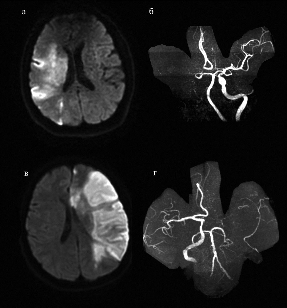 После мрт. Ишемический инсульт кт ангиография. Ишемический инсульт на кт головного мозга. Кт ангиография инсульт. Кт ангиография геморрагический инсульт.