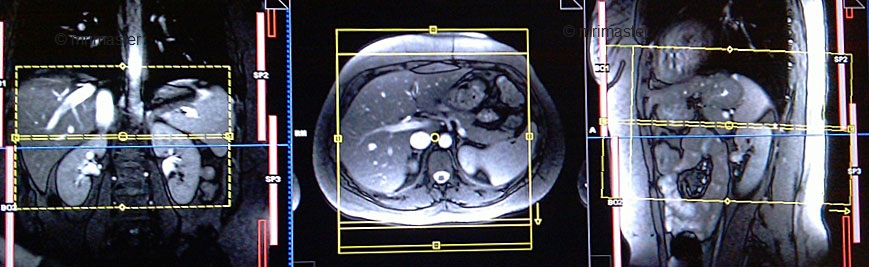 МРТ надпочечников в трёх проекциях