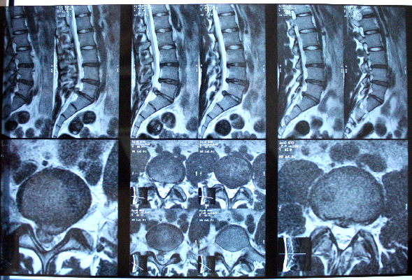 Мр картина дистрофических изменений пояснично крестцового отдела позвоночника