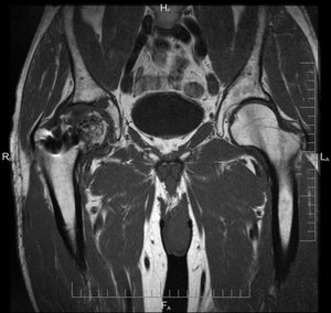 Как проводится мрт тазобедренного сустава фото